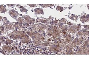 ABIN6273959 at 1/100 staining Human liver cancer tissue by IHC-P. (OR51M1 anticorps  (C-Term))