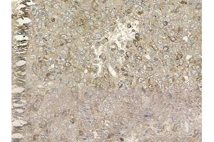 ABIN6257076 and ABIN6275818 at 1/100 staining human melanoma by IHC-P. (Cytochrome P450 2A6V2 (C-Term) anticorps)