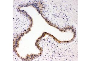 IHC-P: TrkC antibody testing of human breast cancer tissue