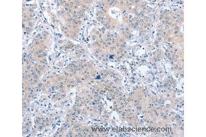 Immunohistochemistry of Human liver cancer using PARD6A Polyclonal Antibody at dilution of 1:60