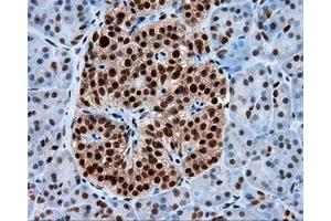 Immunohistochemical staining of paraffin-embedded Adenocarcinoma of colon tissue using anti-KIAA1609 mouse monoclonal antibody. (KIAA1609 anticorps)