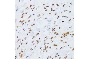 Immunohistochemistry of paraffin-embedded human gastric cancer using DDB1 Antibody. (DDB1 anticorps)
