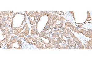 Immunohistochemistry of paraffin-embedded Human thyroid cancer tissue using C9orf116 Polyclonal Antibody at dilution of 1:55(x200) (C9ORF116 anticorps)