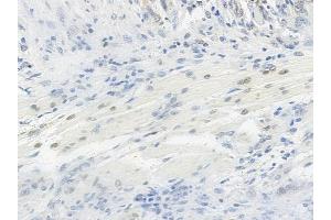 ABIN6254899 and ABIN6267063 at 1/100 staining human tongue carcinoma by IHC-P. (Histone H4 anticorps  (H4K12ac))