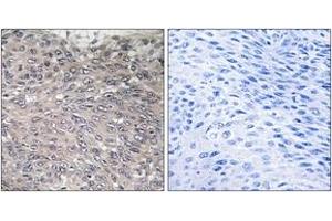 Immunohistochemistry analysis of paraffin-embedded human cervix carcinoma, using Inositol 1, 4, 5-trisphosphate R1 (Phospho-Ser1598/1588) Antibody. (ITPR1 anticorps  (pSer1598))