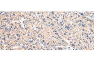 Immunohistochemistry of paraffin-embedded Human liver cancer using VAMP4 Polyclonal Antibody at dilution of 1/30 (VAMP4 anticorps)