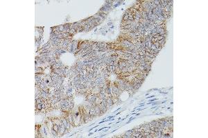 Immunohistochemistry of paraffin-embedded human colon carcinoma using Alkaline Phosphatase (ALPL) Rabbit pAb (ABIN3021385, ABIN3021386, ABIN1512569 and ABIN6214987) at dilution of 1:50 (40x lens).