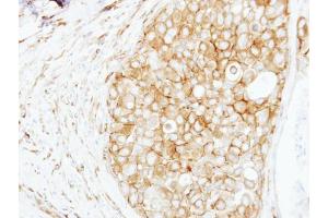 IHC-P Image Immunohistochemical analysis of paraffin-embedded human breast cancer, using Cortactin, antibody at 1:250 dilution.