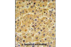 F10 Antibody IHC analysis in formalin fixed and paraffin embedded human hepatocarcinoma followed by peroxidase conjugation of the secondary antibody and DAB staining. (Coagulation Factor X anticorps  (C-Term))