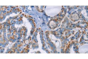 Immunohistochemistry of paraffin-embedded Human thyroid cancer using GPA33 Polyclonal Antibody at dilution of 1:30 (GPA33 anticorps)