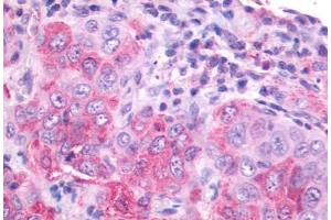 Anti-NMBR antibody IHC staining of human lung, carcinoma. (NMBR anticorps  (Cytoplasmic Domain))