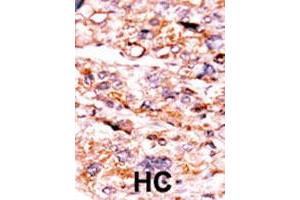 Formalin-fixed and paraffin-embedded human hepatocellular carcinoma tissue reacted with ACVR2A polyclonal antibody  , which was peroxidase-conjugated to the secondary antibody, followed by AEC staining. (ACVR2A anticorps  (N-Term))