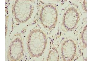 Immunohistochemistry of paraffin-embedded human colon cancer using ABIN7148308 at dilution of 1:100 (COMMD2 anticorps  (AA 5-199))