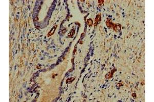 Immunohistochemistry of paraffin-embedded human prostate cancer using ABIN7156227 at dilution of 1:100