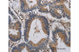 Immunohistochemistry of Human colon cancer using CCR2 Polyclonal Antibody at dilution of 1:20