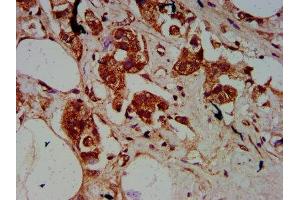 IHC image of ABIN7172918 diluted at 1:500 and staining in paraffin-embedded human breast cancer performed on a Leica BondTM system.