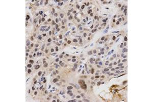 Immunohistochemistry of paraffin-embedded human esophageal cancer using KPNA4 Antibody. (KPNA4 anticorps)