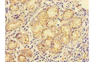 Immunohistochemistry of paraffin-embedded human gastric cancer using ABIN7147004 at dilution of 1:100 (Cathepsin E anticorps  (AA 59-155))