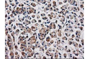 Immunohistochemical staining of paraffin-embedded Adenocarcinoma of Human colon tissue using anti-AQP1 mouse monoclonal antibody. (Aquaporin 1 anticorps)