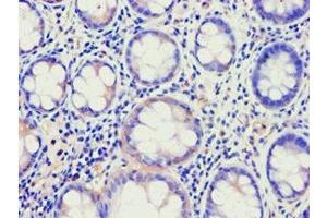 Immunohistochemistry of paraffin-embedded human colon cancer using ABIN7144924 at dilution of 1:100 (ABCE1 anticorps  (AA 320-599))