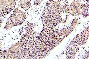 Immunohistochemistry (IHC) analyzes of p-ASK1 antibody in paraffin-embedded human lung adenocarcinoma tissue. (ASK1 anticorps  (pSer83))