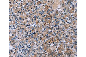 Immunohistochemistry of Human prostate cancer using HSD3B2 Polyclonal Antibody at dilution of 1:50 (HSD3B2 anticorps)