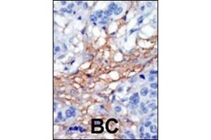 Formalin-fixed and paraffin-embedded human cancer tissue reacted with the primary antibody, which was peroxidase-conjugated to the secondary antibody, followed by AEC staining. (PIP5K1C anticorps  (C-Term))