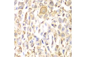Immunohistochemistry of paraffin-embedded human lung cancer using CD151 antibody. (CD151 anticorps)