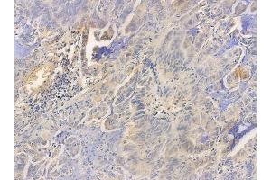 ABIN6256525 and ABIN6267600 at 1/100 staining human lung adenocarcinoma by IHC-P.