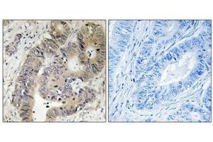 Immunohistochemical analysis of paraffin-embedded human colon carcinoma tissue using CAD (Phospho-Thr456) antibody (left)or the same antibody preincubated with blocking peptide (right).