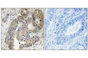 Immunohistochemical analysis of paraffin-embedded human colon carcinoma tissue using CAD (Phospho-Thr456) antibody (left)or the same antibody preincubated with blocking peptide (right). (CAD anticorps  (pThr456))