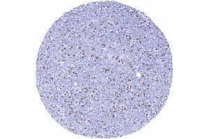 ZAP70 negative B CLL containing a significant number of ZAP70 positive T lymphocytes