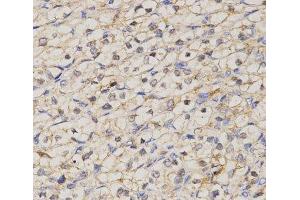 Immunohistochemistry of paraffin-embedded Human kidney cancer using GJC2 Polyclonal Antibody at dilution of 1:200 (40x lens).