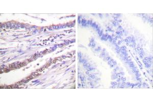 Peptide - +Immunohistochemical analysis of paraffin-embedded human lung carcinoma tissue using Cyclin A antibody (#C0165). (Cyclin A anticorps)