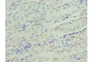 Immunohistochemistry of paraffin-embedded human gastric cancer using ABIN7156368 at dilution of 1:100