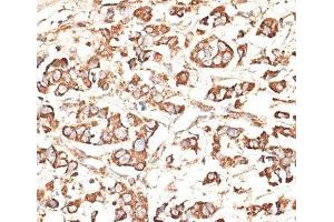 Immunohistochemistry of paraffin-embedded Human mammary cancer using KIR3DS1 Polyclonal Antibody at dilution of 1:100 (40x lens). (KIR3DS1 anticorps)