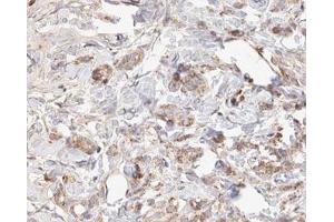 ABIN6266826 at 1/100 staining human Breast cancer tissue sections by IHC-P.