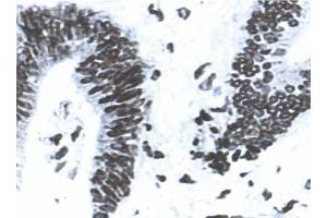Acetone-fixed, frozen tissue section of human colon carcinoma stained for MLH1 (clone G168-15) using a DAB chromogen and Hematoxylin counterstain.