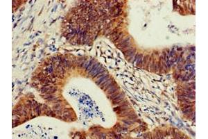 Immunohistochemistry of paraffin-embedded human colon cancer using ABIN7163167 at dilution of 1:100 (PIK3R2 anticorps  (Regulatory Subunit beta))