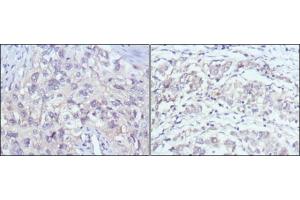 Immunohistochemical analysis of paraffin-embedded human lung cancer (left) and gastric cancer (right) using PAK2 antibody with DAB staining. (PAK2 anticorps)