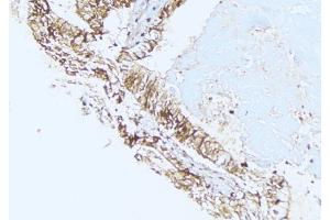 ABIN6275439 at 1/100 staining Human lung cancer tissue by IHC-P.
