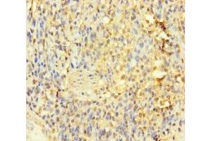 Immunohistochemistry of paraffin-embedded human gastric cancer using ABIN7156759 at dilution of 1:100 (IL1RL2 anticorps  (AA 20-218))