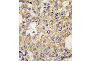 Formalin-fixed and paraffin-embedded human breast carcinoma tissue reacted with Parg antibody , which was peroxidase-conjugated to the secondary antibody, followed by DAB staining.