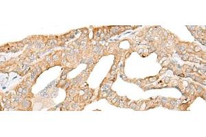 Immunohistochemistry of paraffin-embedded Human thyroid cancer tissue using DDX24 Polyclonal Antibody at dilution of 1:35(x200) (DDX24 anticorps)