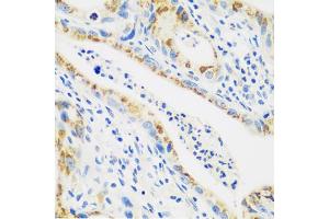 Immunohistochemistry of paraffin-embedded human stomach cancer using CTSG antibody (ABIN5974986) at dilution of 1/100 (40x lens). (Cathepsin G anticorps)