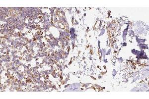ABIN6276656 at 1/100 staining Human Melanoma tissue by IHC-P. (Ghrelin anticorps  (C-Term))