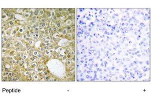 Immunohistochemistry analysis of paraffin-embedded human breast carcinoma tissue using ACVRL1 polyclonal antibody . (ACVRL1 anticorps)