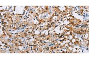 Immunohistochemistry of paraffin-embedded Human thyroid cancer using ATXN1 Polyclonal Antibody at dilution of 1:40 (Ataxin 1 anticorps)