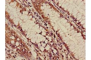 Immunohistochemistry of paraffin-embedded human colon cancer using ABIN7144542 at dilution of 1:100 (ALOX5 anticorps  (AA 2-149))