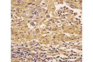 IHC testing of FFPE human cervical cancer with ASS1 antibody at 1:25 dilution.